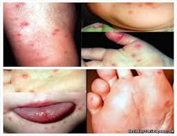 Dehidrasi merupakan komplikasi yang sering terjadi pada penyakit tangan kaki dan mulut. 7 Cara Mencegah Penyakit Tangan Kaki Dan Mulut Anak Anda Sentiasa Panas
