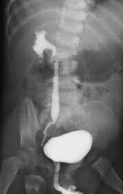 Image result for Voiding Cystourethrogram