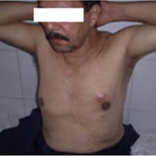 Breast cancer in men is very rare, with only one chance in one thousand (1/1000) of diagnosis. Left Male Breast Cancer Presenting With Breast Lump Scar Of Biopsy Is Download Scientific Diagram