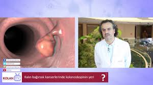 Son dakika sadık yıldırım haberlerini buradan takip edebilirsiniz. Kalin Bagirsak Kanserlerinde Kolonoskopinin Yeri Prof Dr Sadik Yildirim Youtube
