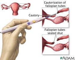 Pin On Birth Control Vs Tubal