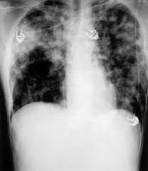 Melioidosis, also called whitmore's disease, is an infectious disease that can infect humans or animals. Pulmonary Melioidosis Associated With Bronchiolitis Obliterans Organizing Pneumonia Journal Of Infection