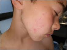 Table of Contents page: Journal of the American Academy of Dermatology