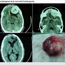 Pdf A Descriptive Study Of Foot Complications In Diabetic Patients With Symptomatic Peripheral Neuropathy