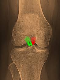 Image result for PCL Sulcus Test