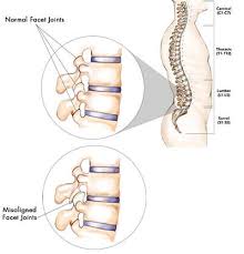 Facet Joint Syndrome Treatment Doctors Back Pain Specialists Nyc