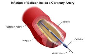 It involves keyhole surgery to place a small balloon at the narrowing in the vessel. Angioplasty Balloon Angioplasty Stanford Health Care