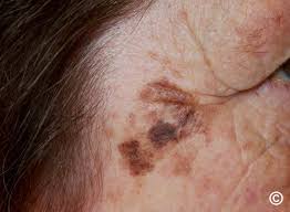 Image result for Solar Lentigo