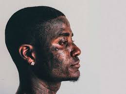 It does cost more than some other types of lip piercing because you will be. Spider Bites Piercing Procedure Side Effects And Aftercare