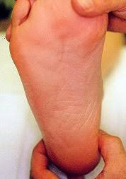 Plantar Fasciitis And Other Causes Of Heel Pain American Family Physician