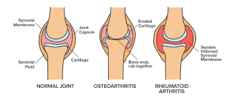 Arthritis And Rheumatoid Arthritis Article Khan Academy