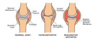 arthritis and rheumatoid arthritis article khan academy