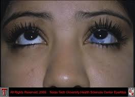 Image result for melanosis sclera