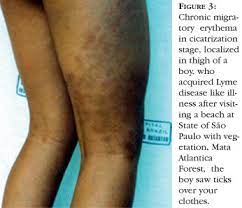 Lyme Borreliosis Simile An Emergent And Relevant Disease To Dermatology In Brazil