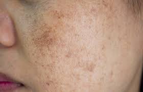 Bio Oil Review And Benefits How To Use Bio Oil For Stretch Marks