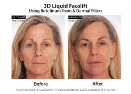 How to reduce saggy jowls and marionette lines using face yoga [bonus: Sagging Face Sagging Facial Skin