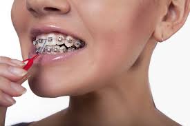 Braces have small ledges, nooks and crannies that can cause food to deposit. Best Toothpaste Mouthwash Floss Orthodontic Kits For Braces Electric Teeth
