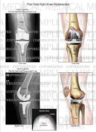 Image result for Knee XRay