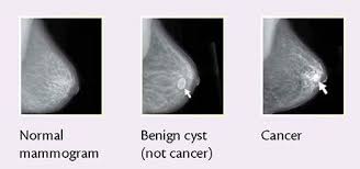 Pin On Excalibur S Breast Imaging Board