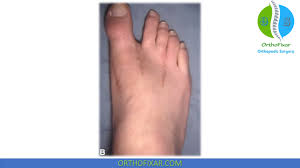 Image result for Hallux Varus