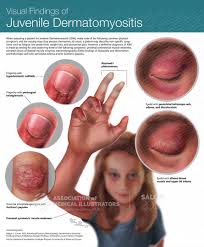 Image result for Dermatomyositis