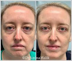 Our eyes say so much about us! 💛 Pictured is my beautiful patient who was  tired of looking & feeling tired. She is pictured 2 months after her upper  and lower eyelid