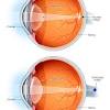 Whilst adapting to these lenses, the wearer. 1