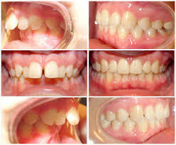 Related videos about how to know if you need braces will i need braces picture test, if you have an overbite do you need braces, do i need braces quiz buzzfeed, how to get braces when you don't need them, do i need braces quiz quotev, can you get braces even if your teeth are straight, do. Do I Need Braces And Why David Schmidt Dds Ypsilanti Dentist