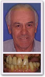 Glendale, CA Dental Implants