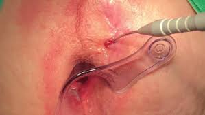 Laser surgery for piles and fistula