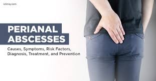Image result for Perianal Abscess