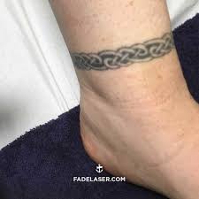 Patients who have had tattoo treatment previously, have green or light blue ink must attend the specialist. Why Does It Take Multiple Sessions To Remove A Tattoo Fade