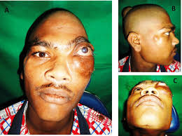 Image result for Gardner Sendromu