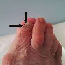 Aside from looking like a changing mole, a melanoma on the foot can appear as a: Pdf Treatment Subungual Melanoma In Foot Case Report