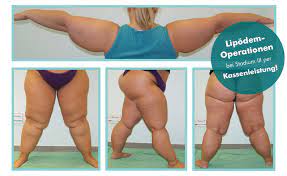 Lipodem Diagnose Und Behandlung Hautarzt Dusseldorf Mvz Dr Cornely