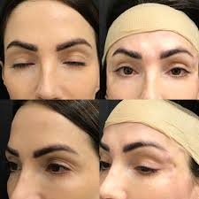 Before and immediately after eyelid filler injection photos are shown. Foxy Eyes Cosmetic Fox Eye Lift Procedure Arviv Medical Aesthetics