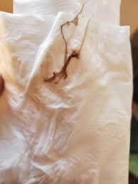 Maybe you would like to learn more about one of these? Implantation Bleeding Picture In Comments Getting Pregnant Babycenter Australia