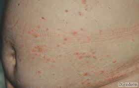 Image result for pruritic urticarial papules and plaques of pregnancy