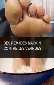 Des Remedes Maison Contre Les Verrues Maison Remede Remedes Contre Verrues Incoming Call Screenshot Tequila Blog