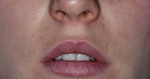 Wenden sie sich deswegen von den. Mundschleimhautveranderungen Fachportal Fur Wehrmedizin Wehrpharmazie