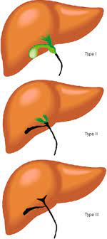 In biliary atresia, the bile duct that leads from the liver to the intestine becomes damaged preventing bile from leaving the liver. Biliary Atresia New Developments Springerlink
