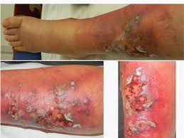 The species was named for benjamin schenck, a medical student w. Cutaneous Nocardiosis