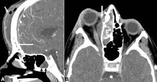 Paranasal Sinus Disease An Overview Sciencedirect Topics