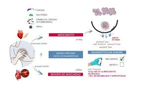 Así, el tratamiento para la miocarditis se basa en los síntomas, como sería la insuficiencia y en las. Identifican El Primer Biomarcador En Sangre Que Distingue La Miocarditis De Un Infarto Agudo De Miocardio El Correo