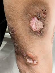 Image result for Pyoderma Gangrenosum
