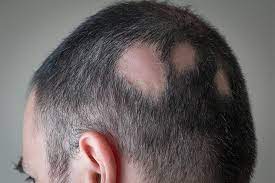 Many people experience hair loss. New Insights Into Radiation Induced Hair Loss