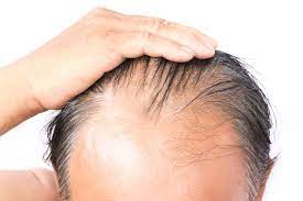 Both eczema and seborrhea are types of dermatitis that cause flaky red and itchy patches to develop on the skin. 10 Things You Should Know About Male Hair Loss