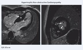 .по современным данным, составляет от 0,12 до 12 % (current state of knowledge on aetiology, diagnosis, management, and therapy of myocarditis. Die Rolle Der Kardio Mrt Bei Diagnose Und Prognosebeurteilung Der Herzinsuffizienz Springerlink