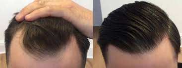 Shock loss is not uncommon, and it is a temporary … Fue Hair Transplantation Cost In Dubai Abu Dhabi Hair Transplant In Dubai Cost