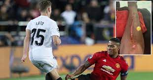 Antonio valencia was forced off the pitch with a hamstring injury at west brom. Antonio Valencia Posts Gruesome Picture Of Leg After Being Slammed For Shocking Tackle Irish Mirror Online
